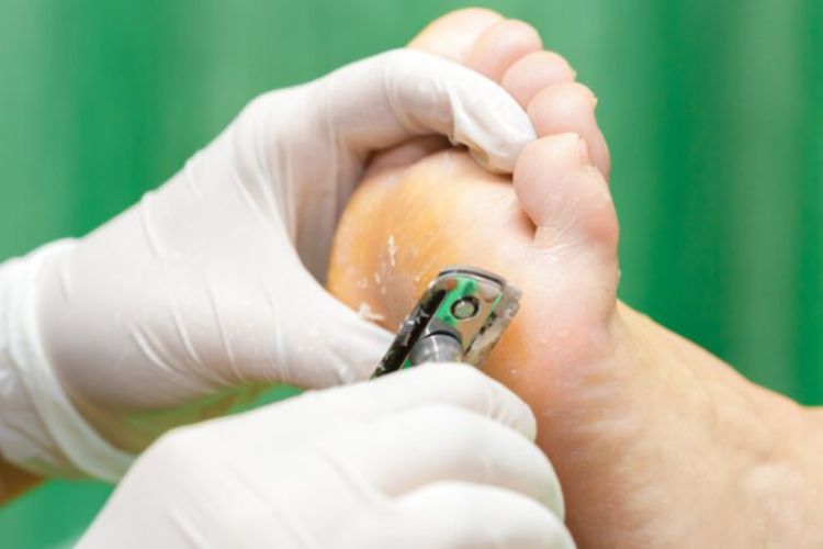 Foot Corn Causes And Treatment