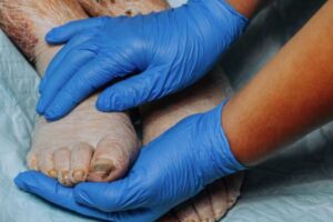 Diabetic Foot Treatment